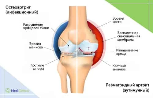 Чем отличается остеоартрит от ревматоидного артрита Схематическая иллюстрация коленного сустава, разделенного на две части: слева показан остеоартрит с разрушением хрящевой ткани, справа — ревматоидный артрит с воспалением и эрозией кости