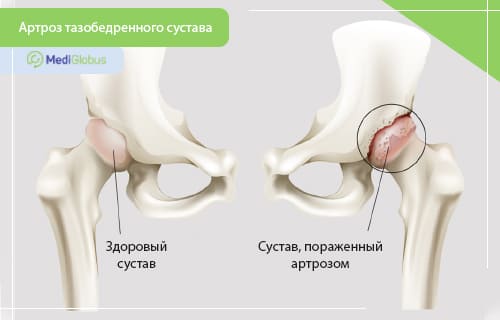 Артрит коленного сустава - симптомы, степени и лечение