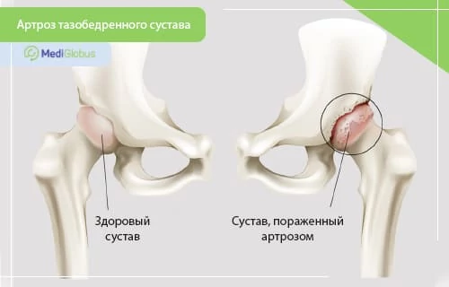 Что такое артроз, какие его симптомы иллюстрация сравнения здорового тазобедренного сустава и сустава, пораженного артрозом