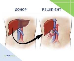 liverdonation_ukr як проводиться пересадка печінки за кордоном