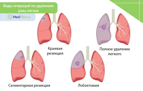 хирургическое лечение рака легких схематические изображения различных видов операций при раке легких