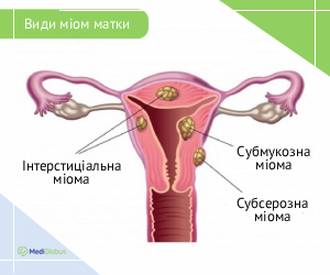 uterine_myomas_ukr Види міом матки