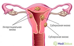 Лапароскопическая миомэктомия: операция по удалению миомы матки