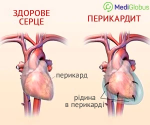 healthy_vs_pericarditis_ukr Порывняння здорового серця з перикардитом