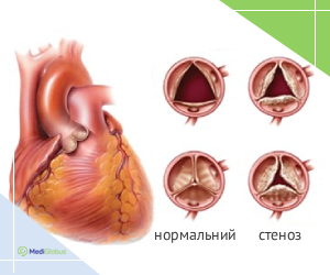 normal_vs_stenosis_ukr Порівняння здорового і стенозного клапанів серця