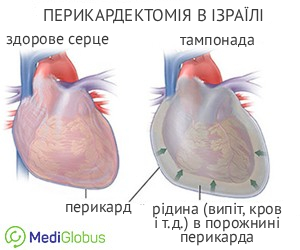 pericardectomy_israel_ukr Проведенния перикардектомії в Ізраїлі