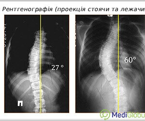 spine_xray_ukr рентген хребта при сколіозі
