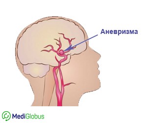 удаление аневризмы головного мозга