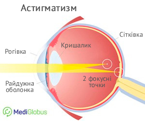 Астигматизм ока