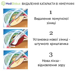 cataract_removal_germany_ukr_2 Етапи операції з видалення катаракти в Німеччині