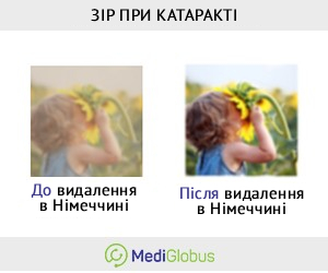 cataracts_eyesight_ukr Порівняння зору до та після лікування в Німеччині