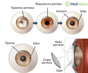 cornea_replacemet_ukr Як проводиться пересадка рогівки