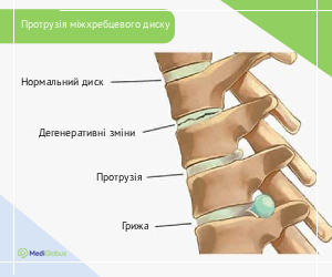 disk_protrusion_ukr Протрузія міжхребцевих дисків