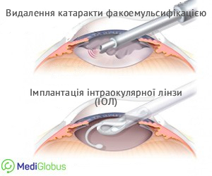 iol_ukr Установка ІОЛ при катаракті