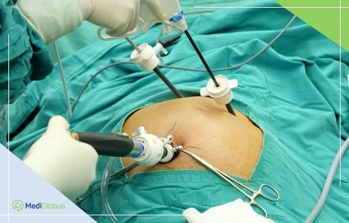 removal of gastric cancer at stage 3