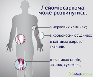 leiomyosarcom_ukr Місця розвитку лейоміосаркоми
