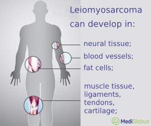 leiomyosarcoma infographic