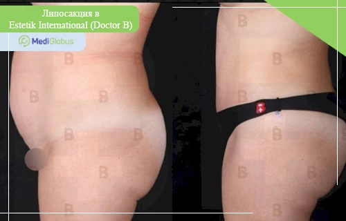 Липосакция у доктора В, клиника Естетик Интернешнл Фотографии до и после липосакции в клинике Естетик Интернешнл