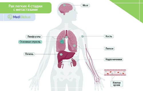 лечение рака легких 4 стадии