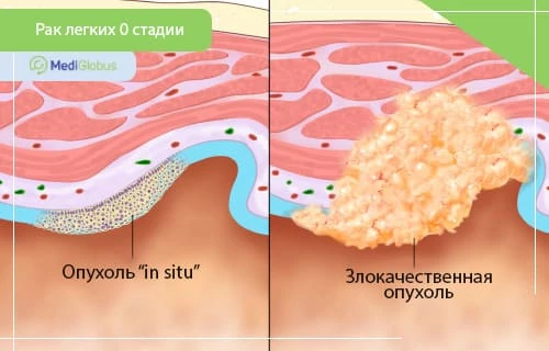 сравнение двух стадий рака легких: слева - опухоль in situ, ограниченная поверхностным слоем ткани; справа - злокачественная опухоль, прорастающая вглубь тканей
