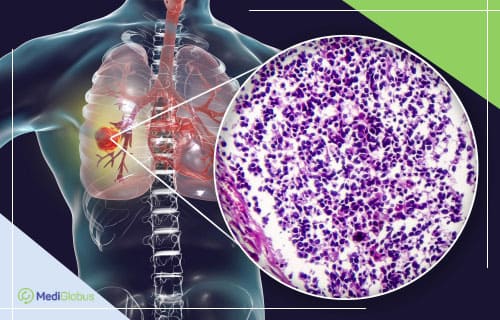лечение рака легких 3 стадии