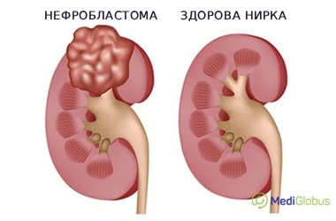nephroblastoma_vs_healthy_kidney_ukr Порівняння здорової нирки та нирки з нефробластомою