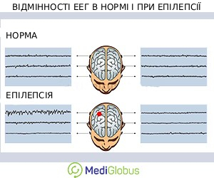 norm_vs_epilepsy_eeg_ukr Порівняння ЕЕГ здорової людини і при епілепсії