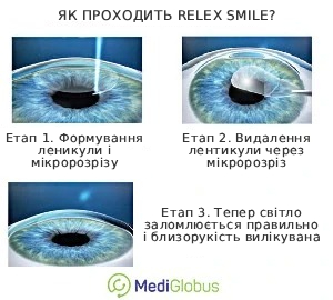 relex_smile_ukr Як проходить корекція зору за методом ReLEX SMILE