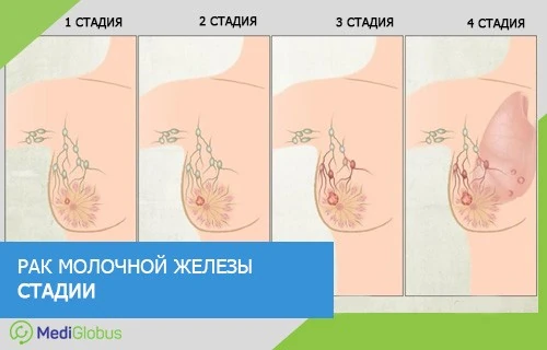 стадии рака груди схематические изображения 1–4 стадий развития рака молочной железы с постепенным поражением окружающих тканей и лимфатических узлов