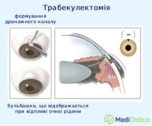 trabeculectomy_ukr Операція трабекулектомія схема