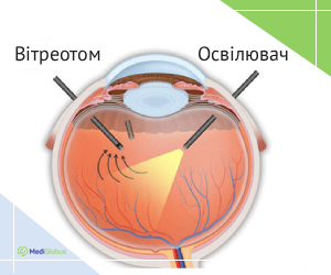 vitrectomy_ukr Вітректомія в Німеччині