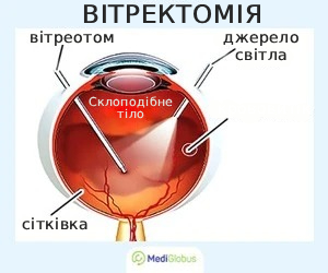 vitrectomy_ukr Вітректомія схема