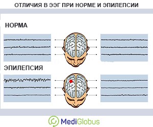 Что такое электрическая активность мозга