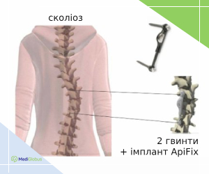 apifix_ukr Лікування сколіозу системою ApiFix