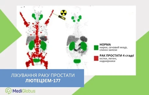 Як працює PSMA-терапія з лютецієм-177 — візуалізація поширення раку простати та принцип дії радіоізотопного лікування Порівняльне зображення двох сканів тіла людини: ліворуч червоні ділянки позначають метастази раку простати 4-ї стадії, праворуч зелені — нормальні органи; поруч — умовні позначення кольорів та символ радіації