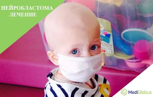 лечение нейробластомы за границей ребенок без волос на голове и в медицинской маске