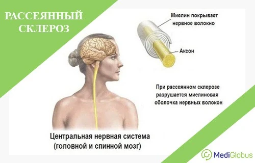 Сколько стоит лечение рассеянного склероза за рубежом?
