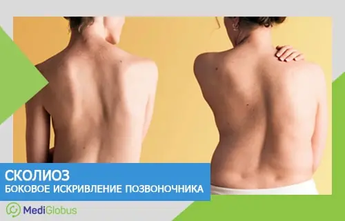 Искривление позвоночника (сколиоз) Две фотографии спины с разными степенями искривления позвоночника