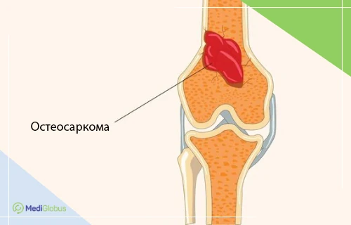 локализация опухоли в костной ткани схематическое изображение сустава с выделенной областью остеосаркомы