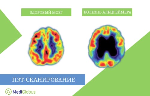 Сравнение ПЭТ сканирования здорового мозга и болезни Альцгеймера