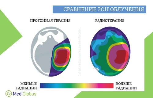 Сравнение поражения мозга радиацией при протонной терапии и радиотерапии Инфографика: Сравнение поражения мозга радиацией при протонной терапии и радиотерапии