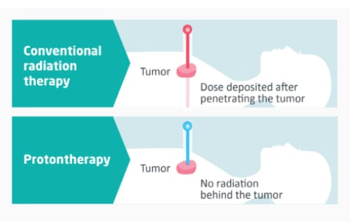what is the difference between proton therapy and radiotherapy