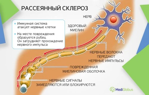 Терапия рассеянного склероза — современные методы и последние достижения