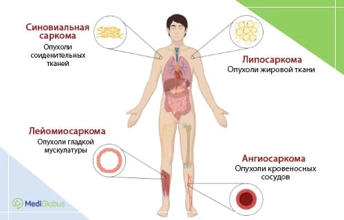 Что такое саркома мягких тканей?