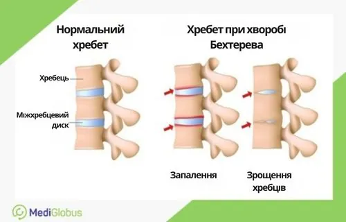 Інфографіка: пошкодження суглобів при хворобі Бехтерева