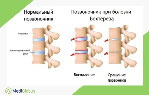 Инфографика: Повреждение суставов при болезни Бехтерева