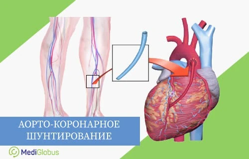 Как проводят аорто-коронарное шунтирование за рубежом