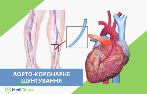 Що таке аорто-коронарне шунтування Медична схема аорто-коронарного шунтування: зображено вени на ногах та серце зі встановленим шунтом для відновлення кровотоку