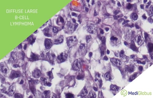 diffuse large b-cell non-hodgkins lymphoma