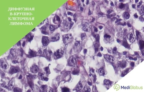 Перспективные методы лечения диффузной В-крупноклеточной лимфомы